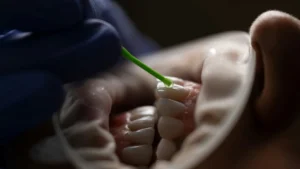 Sbiancamento Dentale